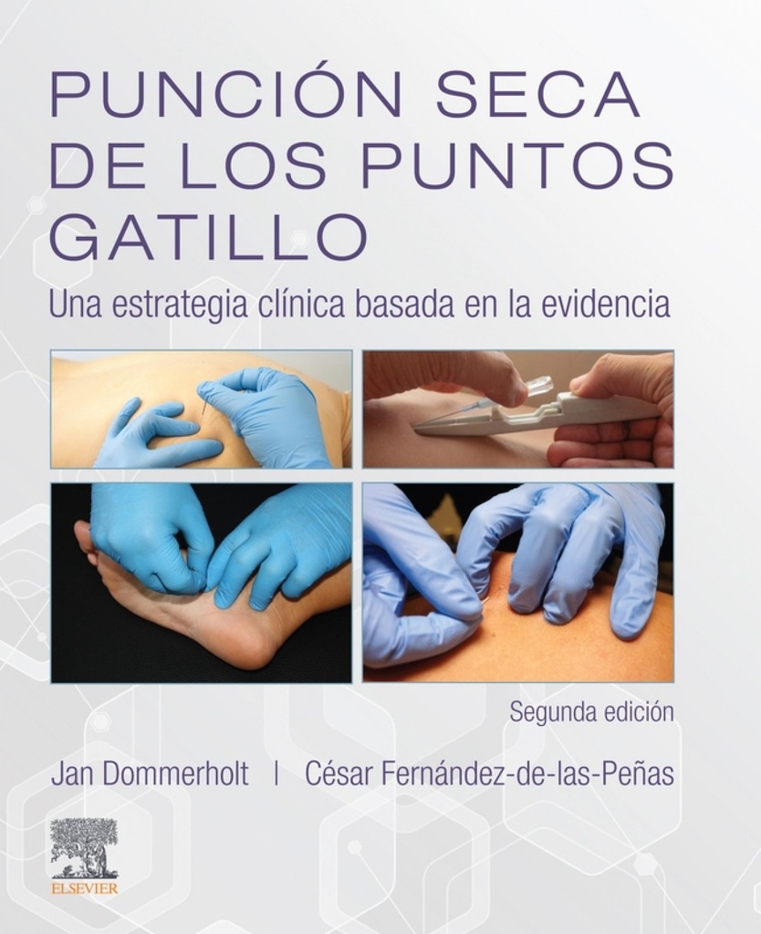 PUNCIÓN SECA DE LOS PUNTOS DE GATILLO