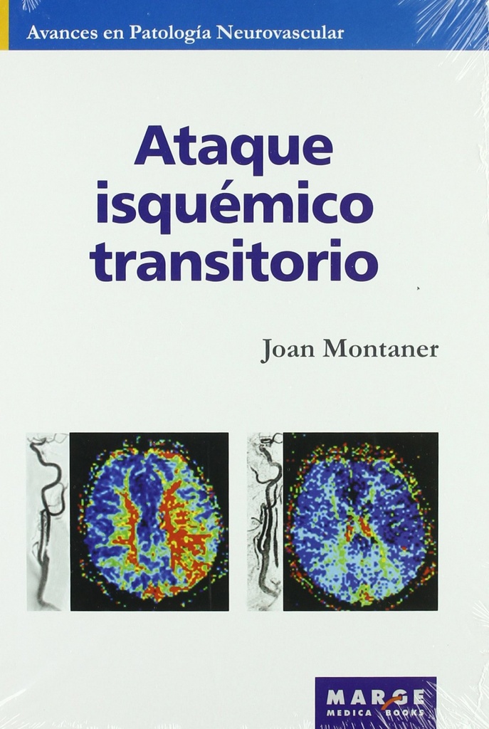 Ataque isquémico transitorio