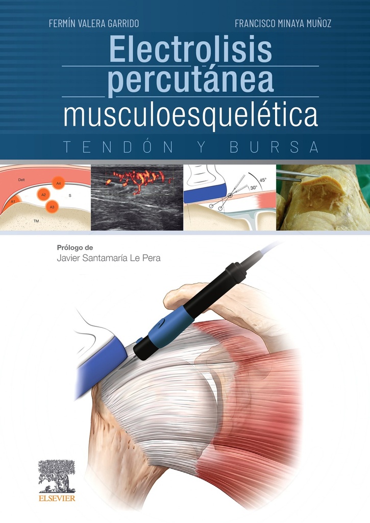 Electrolisis percutánea musculoesquelética. Tendón y bursa