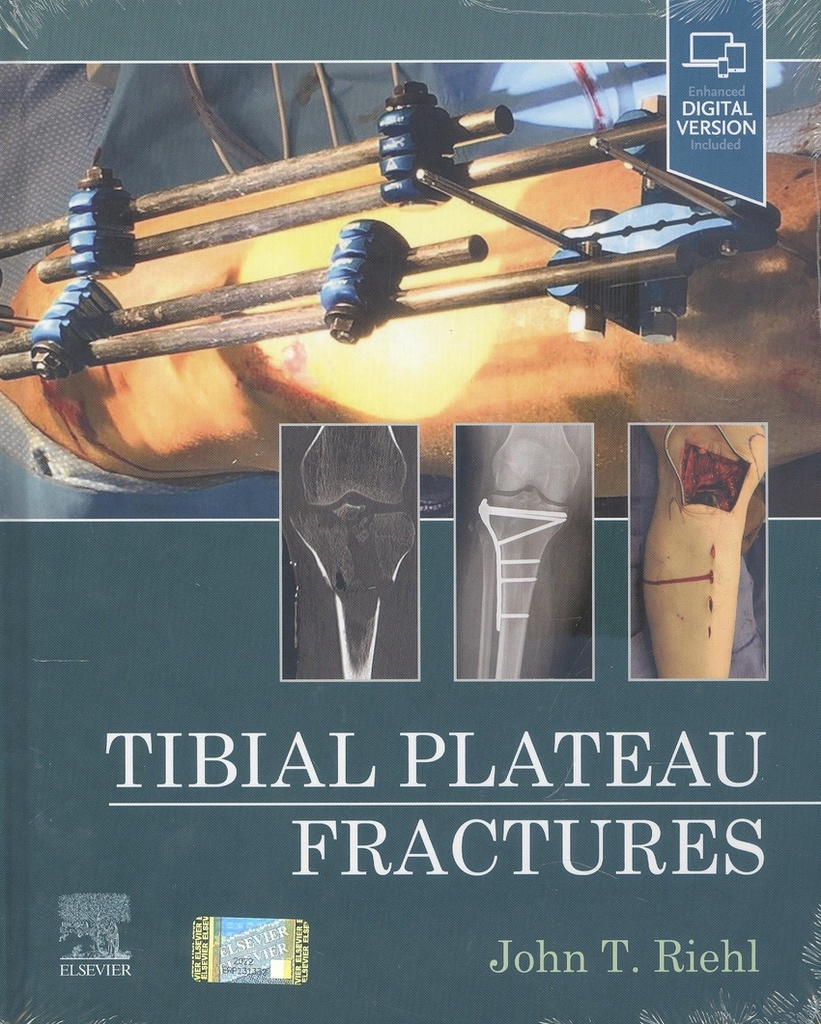 Tibial Plateau Fractures