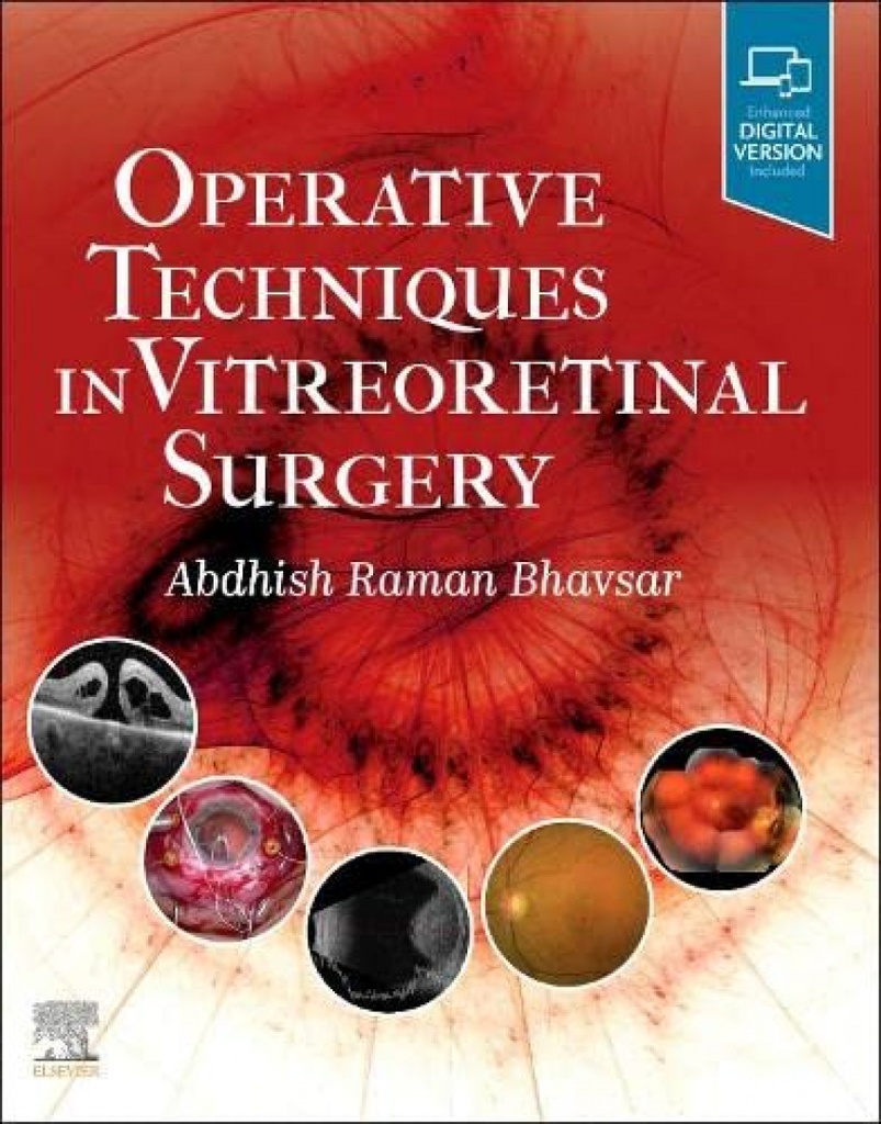 OPERATIVE TECHNIQUES IN VITREORETINAL SURGERY