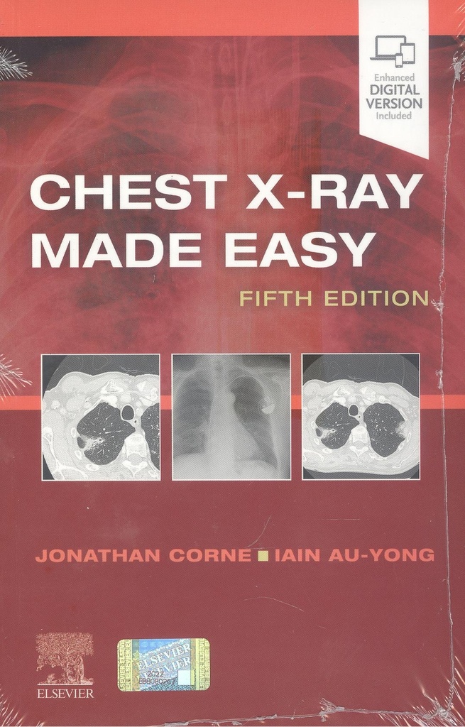 CHEST X-RAY MADE EASY