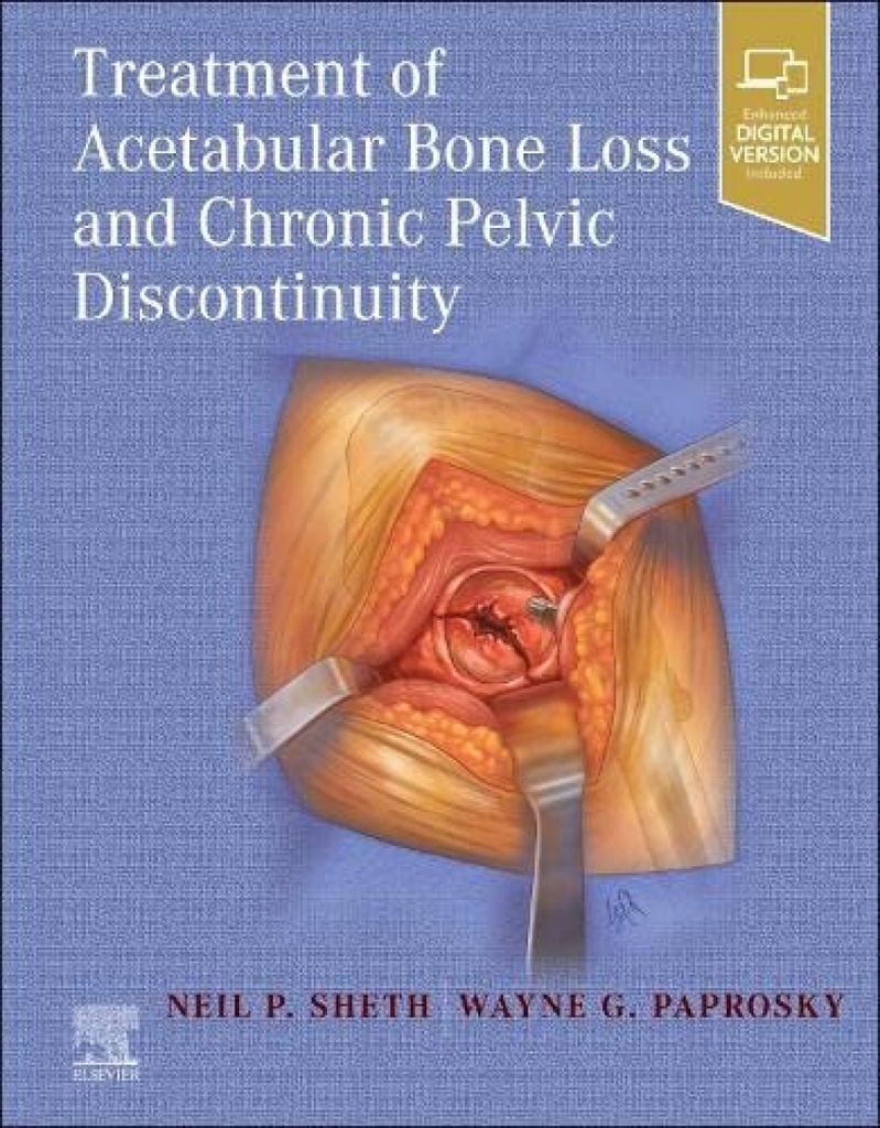 Treatment of acetabular bone loss and chronic pelvic