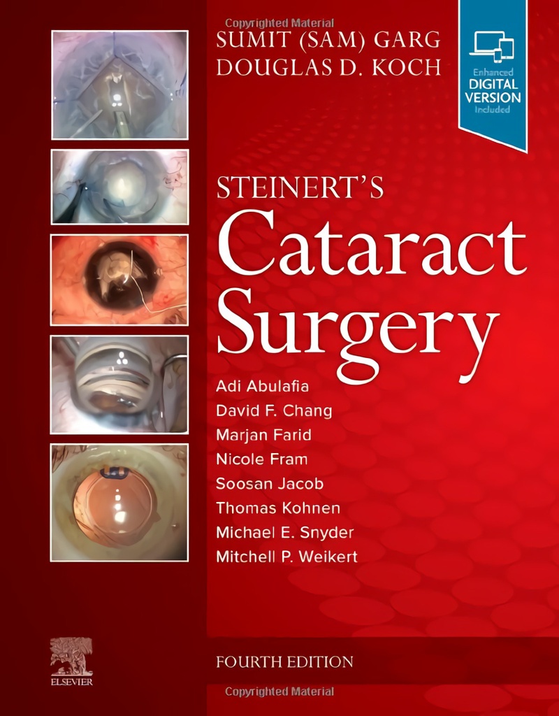 Steinert´s cataract surgery